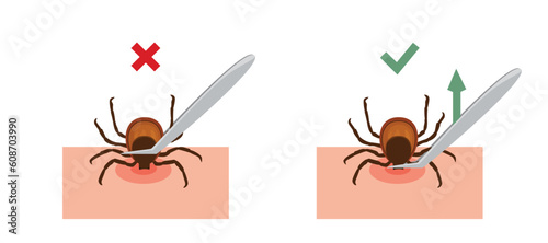Correct way to remove tick of skin after bite insect correctly, vector