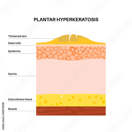 Plantar hyperhidrosis poster
