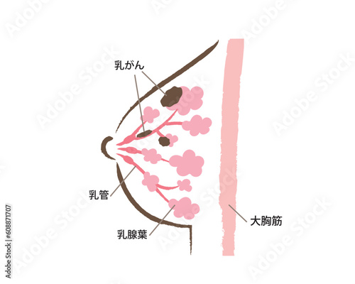 乳がんのバストの断面図のイラスト