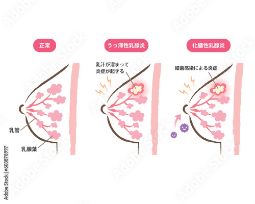 乳腺炎のバストの断面図のイラスト