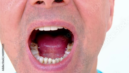 dental prosthetist examines oral cavity patient, charismatic mature man 60 years old open mouth, shows teeth with temporary fillings and metal, titanium pins for prosthetics or splinting, prosthetics photo