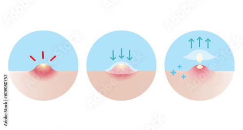 Direction for use acne pimple patch for inflammatory acne vector icon set illustration on white background. How to use, step for use acne patch absorbing pustule on skin face. Skin care concept.