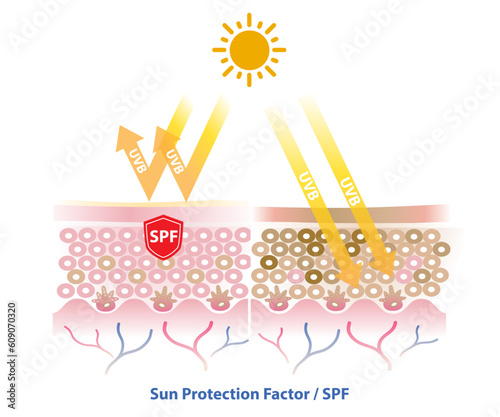 SPF (Sun protection factor) blocks UVB radiation penetrate into the skin layer vector on white background. Comparison of skin with sunscreen and no sunscreen. Skin care and beauty concept.