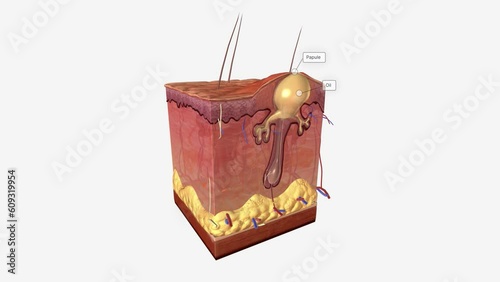 Acne Papule Papule is a type of acne characterized by a large, inflamed bump on the skin.