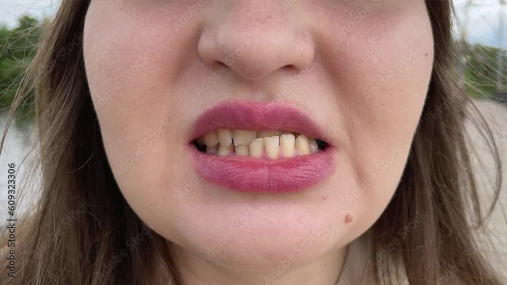 Patient with dislocated jaw and malocclusion, temporomandibular joint