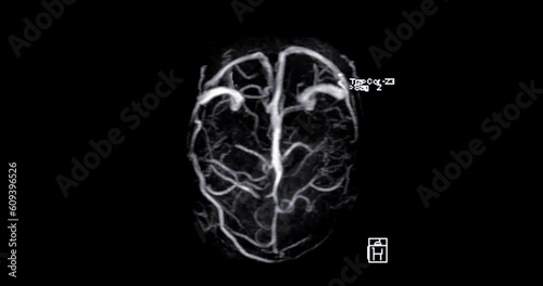 MRV Brain  or MR cerebral venography for diagnostic Cerebral venous thrombosis (blood clots in the brain) and 
Structural vein abnormalities. photo