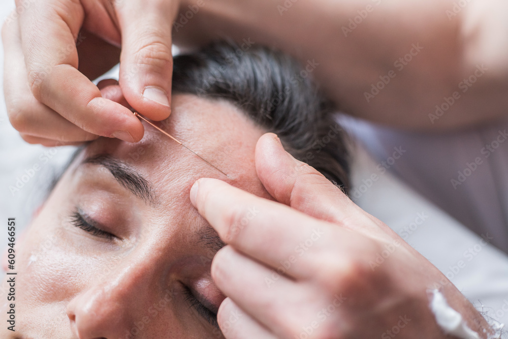 Young Caucasian woman having acupuncture sessions on her face as a beauty, anti-aging treatment. Concept of controlled aging and beauty and body care. Close-up view of the procedure. Selective focus - obrazy, fototapety, plakaty 