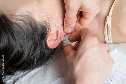 Young Caucasian woman having acupuncture sessions on her face as a beauty  anti-aging treatment. Concept of controlled aging and beauty and body care. Close-up view of the procedure. Selective focus