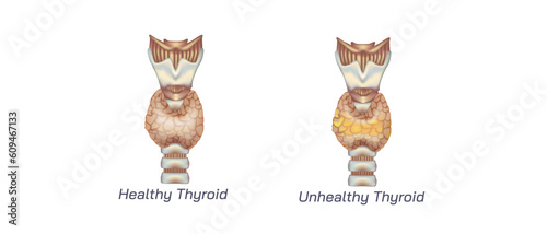 hypothyroidism vs hyperthyroidism. healthy and unhealthy thyroid test. Thyroid tumour and inflammation treatment. Parathyroid glands. neck pain and sore. Throat cancer and esophagus. Goitre problem. 