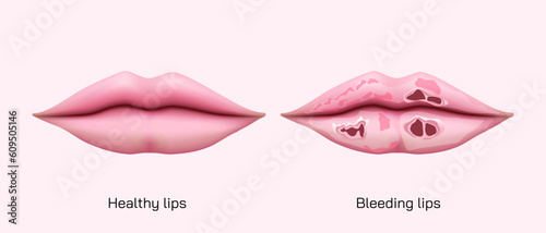 Chronic angular cheilitis problem. Dry chapped lips vector illustration. symptoms of Ripped lips skin. Disease of the mouth. sore lips, skin flakes. Vector illustration. lips ulcer and cancer symptoms