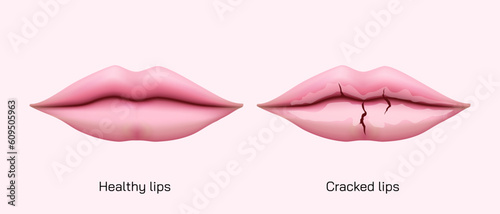 Chronic angular cheilitis problem. Dry chapped lips vector illustration. symptoms of Ripped lips skin. Disease of the mouth. sore lips, skin flakes. Vector illustration. lips ulcer and cancer symptoms