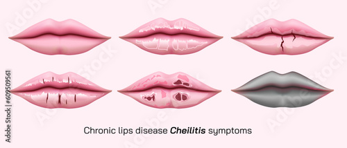 Chronic angular cheilitis problem. Dry chapped lips vector illustration. symptoms of Ripped lips skin. Disease of the mouth. sore lips, skin flakes. Vector illustration. lips ulcer and cancer symptoms