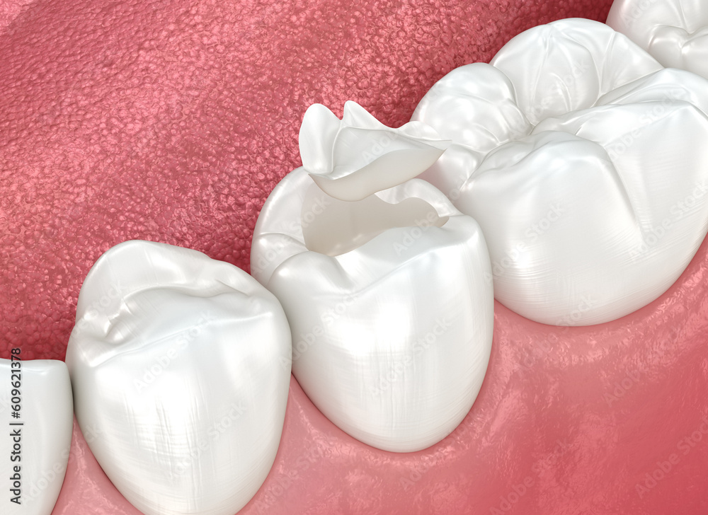 Inlay ceramic crown placement. Medically accurate 3D animation Inlay ceramic crown placement. Medically accurate 3D animation