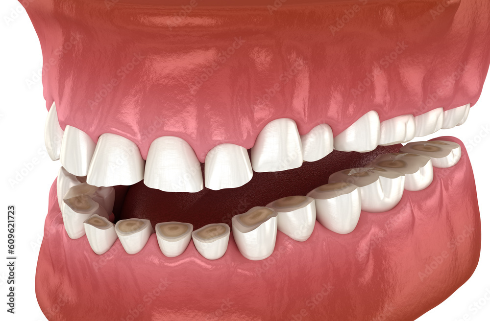 Obraz premium Dental attrition (Bruxism) resulting in loss of tooth tissue. Dental 3D illustration