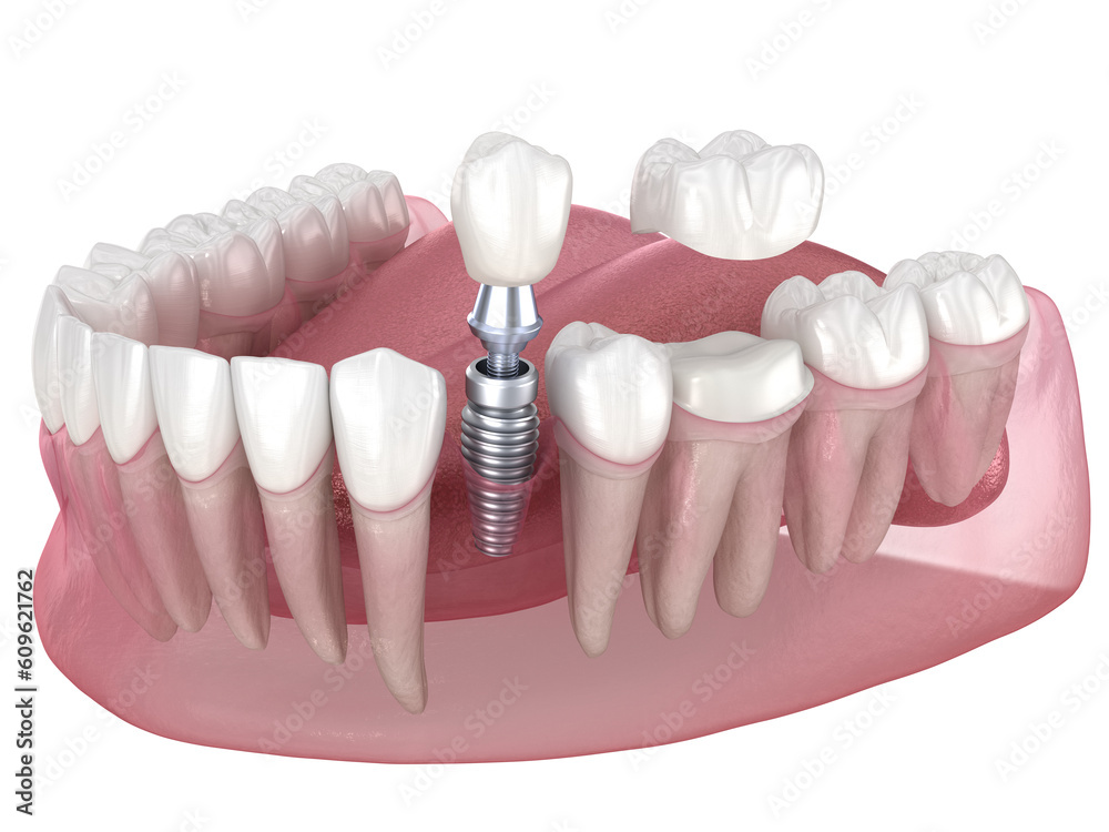 Dental implant and ceramic crown. Medically accurate tooth 3D illustration.