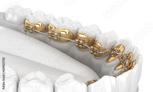 Lingual braces system. 3D illustration concept of golden braces