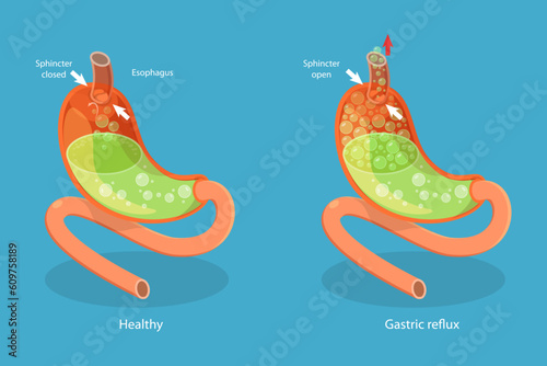3D Isometric Flat Vector Conceptual Illustration of Stomach Reflux, Digestive System Problems photo