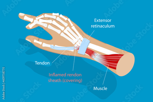 3D Isometric Flat Vector Conceptual Illustration of De Quervain Syndrome, Occupational Disease of the Hand