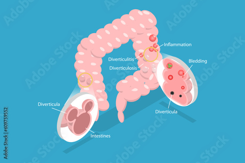 3D Isometric Flat Vector Conceptual Illustration of Diverticulosis And Diverticulitis, Medical Structure and Location