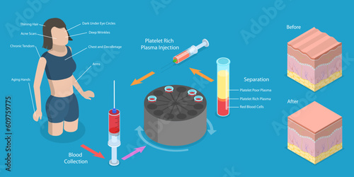 3D Isometric Flat Vector Conceptual Illustration of PRP Procedure, Women Beauty and Skincare