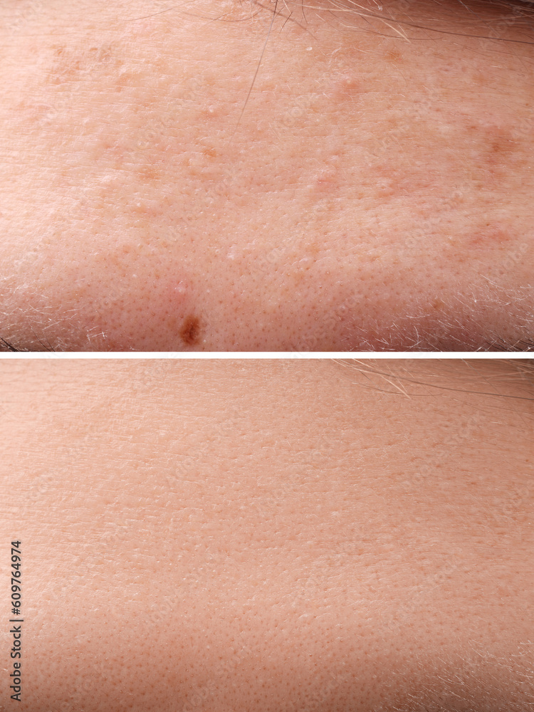 Fototapeta premium Collage with photos of woman with acne problem before and after treatment, closeup