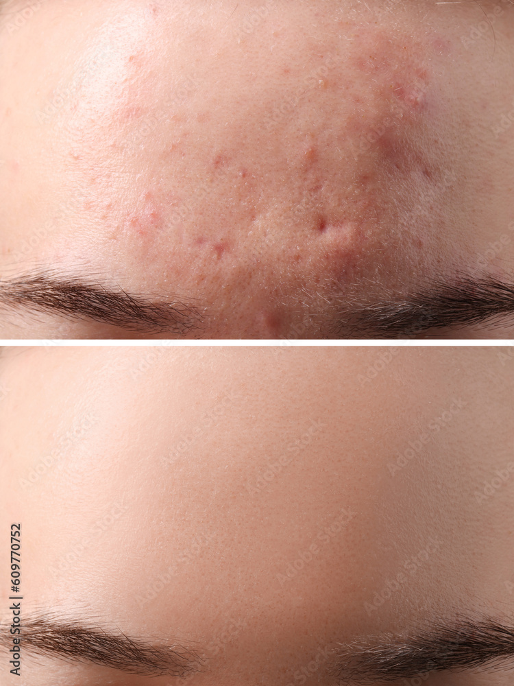 Fototapeta premium Collage with photos of woman with acne problem before and after treatment, closeup