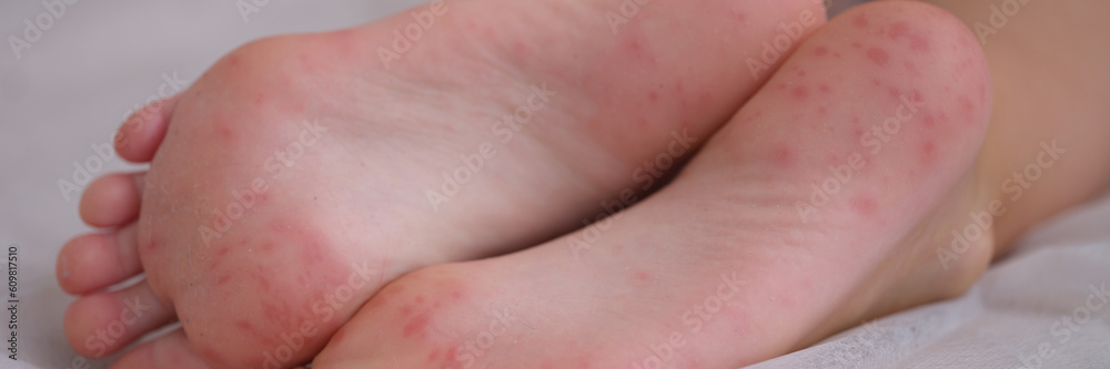 Eczema is an irritation caused by an allergic lesion of skin of feet in child. Infectious skin diseases in children Eczema is an irritation caused by an allergic lesion of skin of feet in child. Infectious skin diseases in children