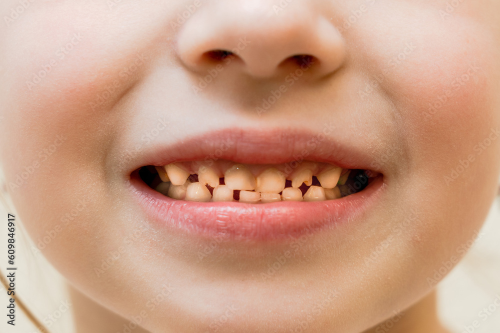 Close up view on of child milk teeth Close up view on of child milk teeth