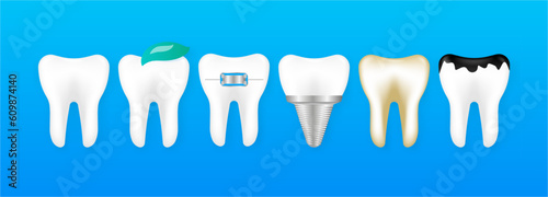 White and decayed teeth, dental implant. Different tooth conditions. Dental model of teeth in the gum. Dental care concept. Vector Illustration.