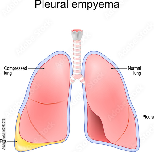 Pleural empyema.