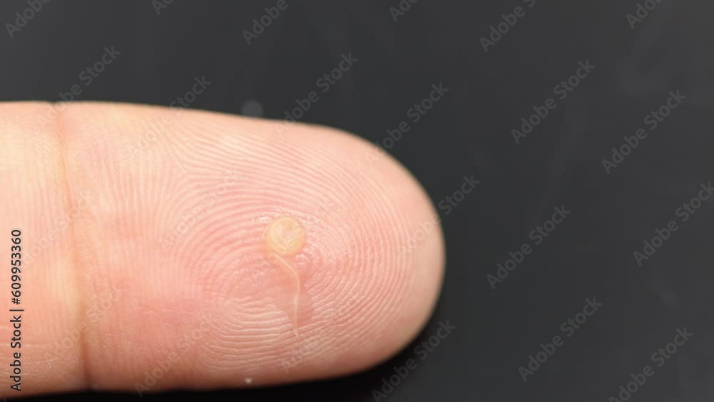 A live anisakis parasitic worm coiled on the finger of a human hand A live anisakis parasitic worm coiled on the finger of a human hand