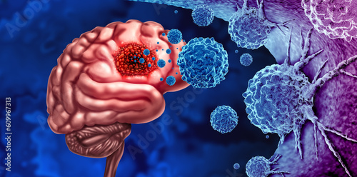 Glioma Cancer Tumor as malignant cells outbreak as a brain disease attacking neurons as a medical concept of neurological disease photo