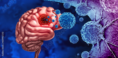 Tableau sur toile Glioma Cancer Tumor as malignant cells outbreak as a brain disease attacking neu