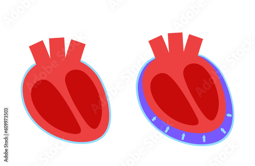 Pericardial effusion heart