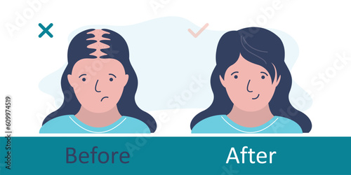 Bald woman before and after hair transplantation. Unhappy girl with hair loss problem, alopecia, front view. Hair transplant surgery. Healthy hair. Head baldness problem solving surgery.
