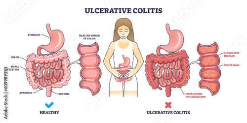 Ulcerative colitis as chronic inflammatory bowel disease outline diagram. Labeled educational scheme with medical illness of digestive system vector illustration. Ulcers inflammation description. photo