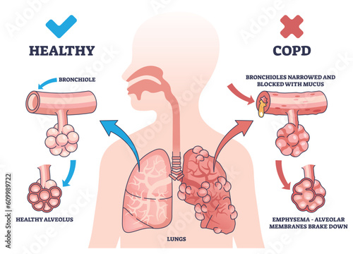 COPD or chronic obstructive pulmonary disease explanation outline diagram. Labeled educational medical scheme with healthy and respiratory illness lungs comparison vector illustration. Body diagnosis