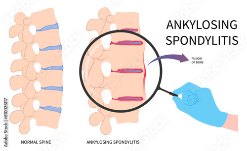 scoliosis kyphoscoliosis disease in axial ankylosing spondylitis osteoporosis and fused spine disk of kyphosis lordosis the skeletal pelvis stiffness with chronic knee ankle spondylolysis