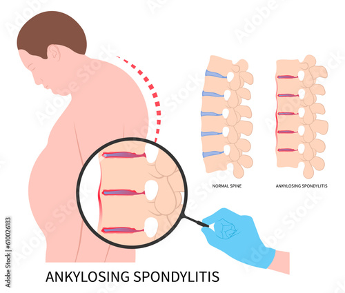 lordosis scoliosis kyphoscoliosis disease in axial ankylosing spondylitis osteoporosis and fused spine disk of kyphosis the skeletal pelvis stiffness with chronic knee ankle spondylolysis