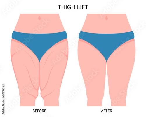 Thigh lift or Thighplasty leg cosmetic weight loss bariatric surgery with body hip Liposuction cellulite reducing contour of mass Index and BMI removal