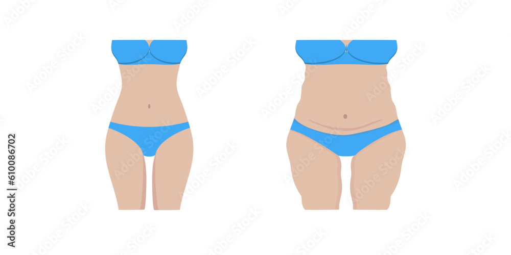 Vector illustration of a fat and thin female body. Isolated white background. Female body before and after weight loss. Flat style. Girl's stomach and breasts after weight loss