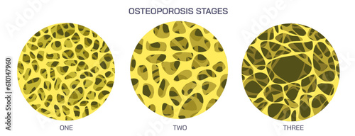 Bone density measurements and stages of osteoporosis. A bone disease that develops when bone mineral density and bone mass decreases, or the quality or structure  changes. vector illustration.