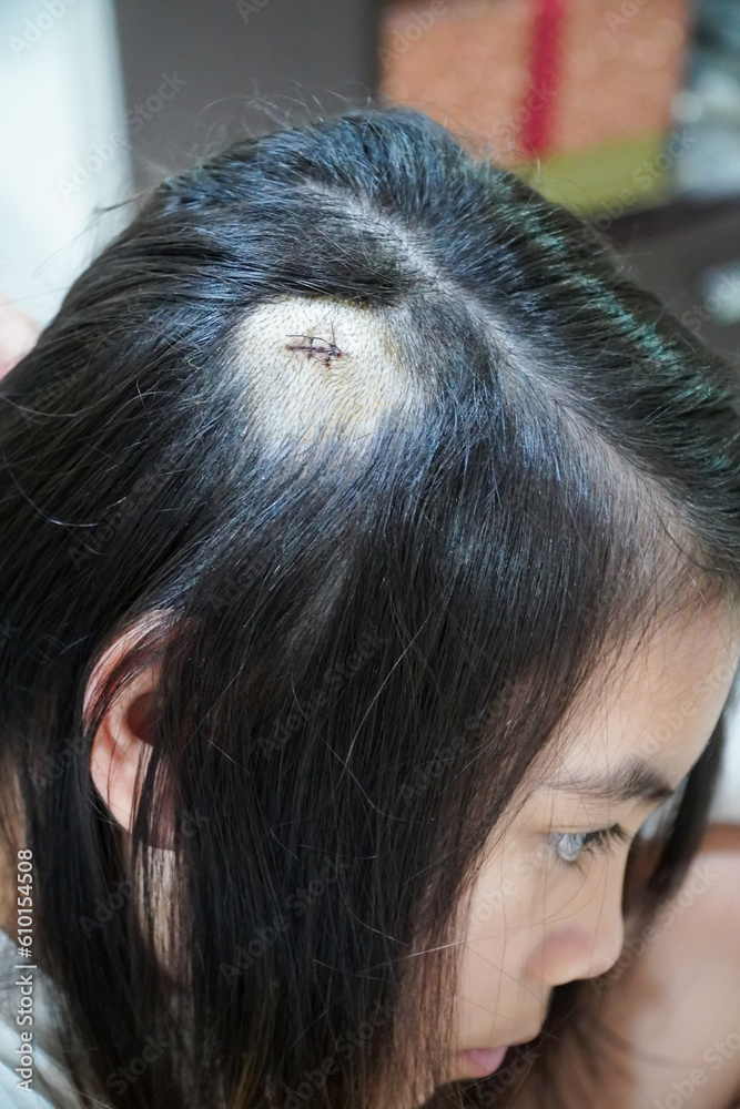 Stitches In Head