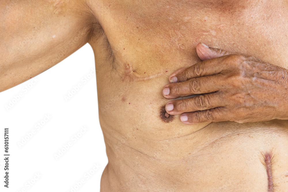 Naklejka premium Close up of Scar caused by abdominal aorta surgery in elderly men. Cyanotic keloid Scars caused by abdominal surgery and suturing. skin imperfections or defects.