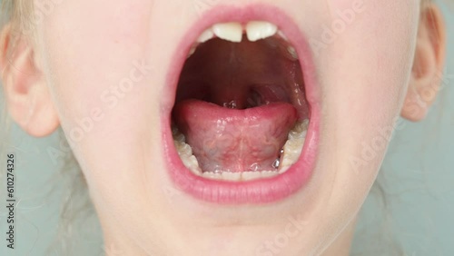 Wide open mouth with small uvula, palate and larynx. The child opened his mouth. Children's dentistry. Children's therapist, throat treatment. Overview of baby throat
