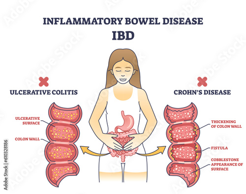 Inflammatory bowel disease or IBD with Crohns condition and ulcerative colitis outline diagram. Labeled educational scheme with chronic inflammation of gastrointestinal tract vector illustration. photo