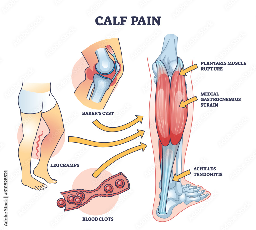 Calf Pain Explanation With Cramp From Muscle Contraction Outline 