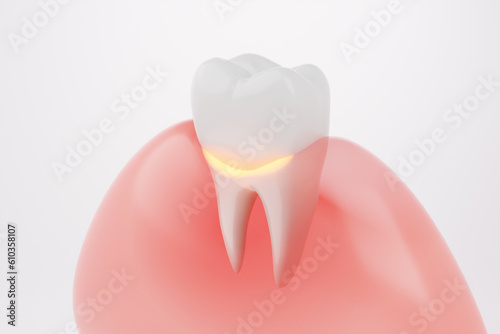 Gums gingivitis disease with teeth on white background. 3D rendering.