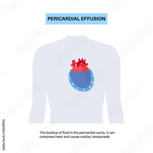 Pericardial effusion heart