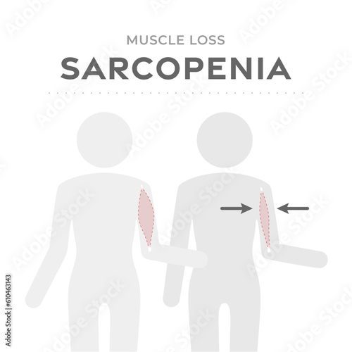 Sarcopenia, muscle loss medical scheme. Vector illustration with human body pictogram comparing normal Healthy muscle mass and weak old muscle atrophied in the aging process.  Medical infographic photo